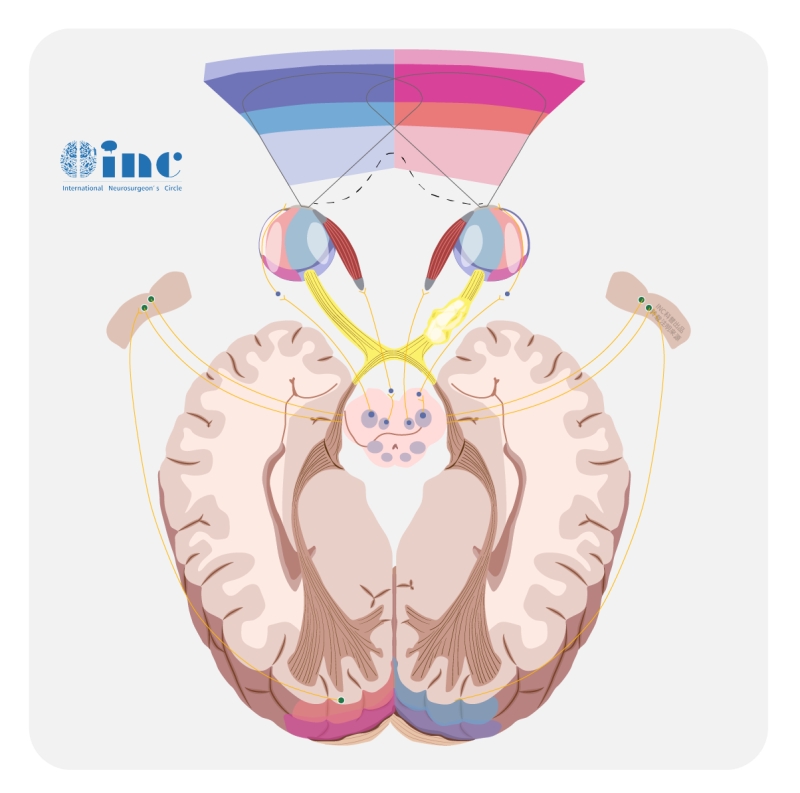 脑胶质瘤死亡过程是怎么样的？