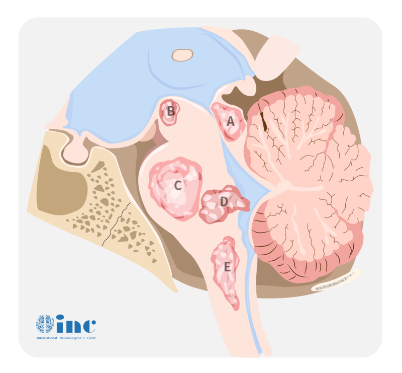 胶质瘤分几级？