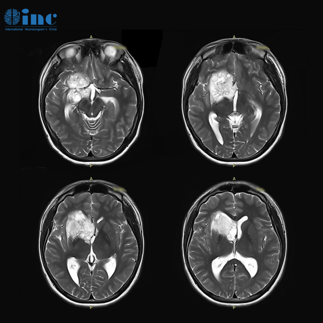 16岁学生基底节胶质瘤案例回访：影像