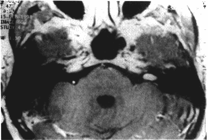 不同大小的听神经瘤治疗方案有何区别？
