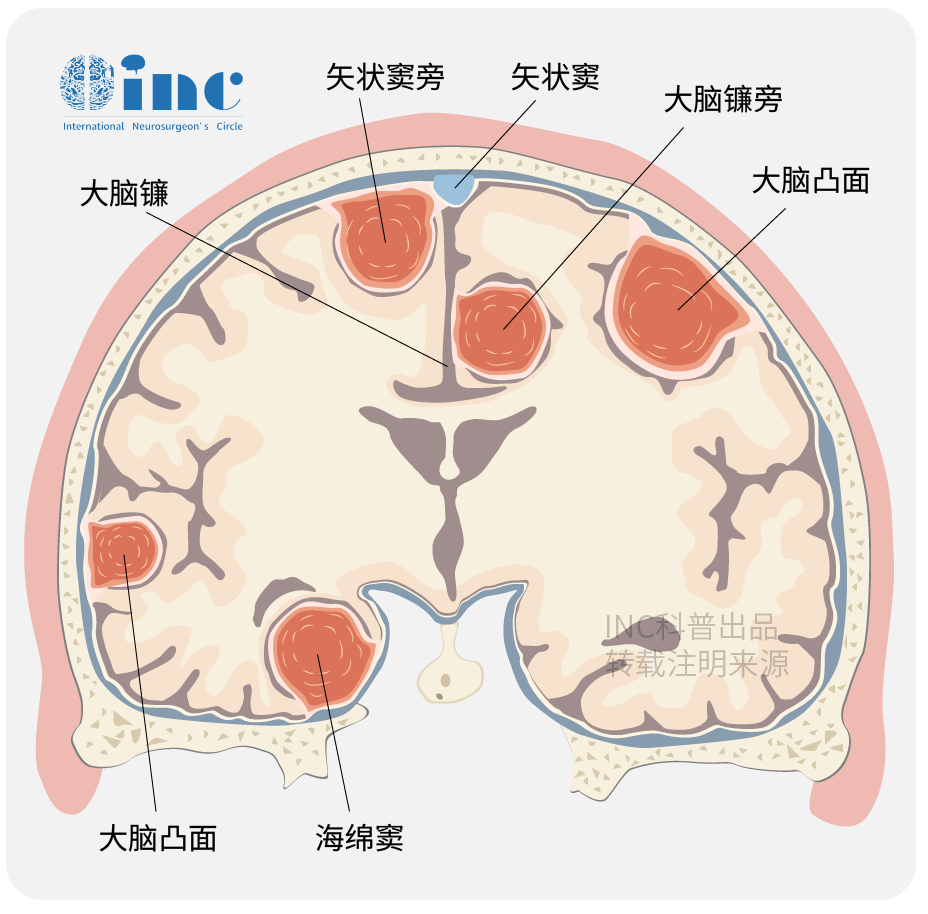 脑膜瘤手术后能活20年吗？影响脑膜瘤生存率的因素有哪些？