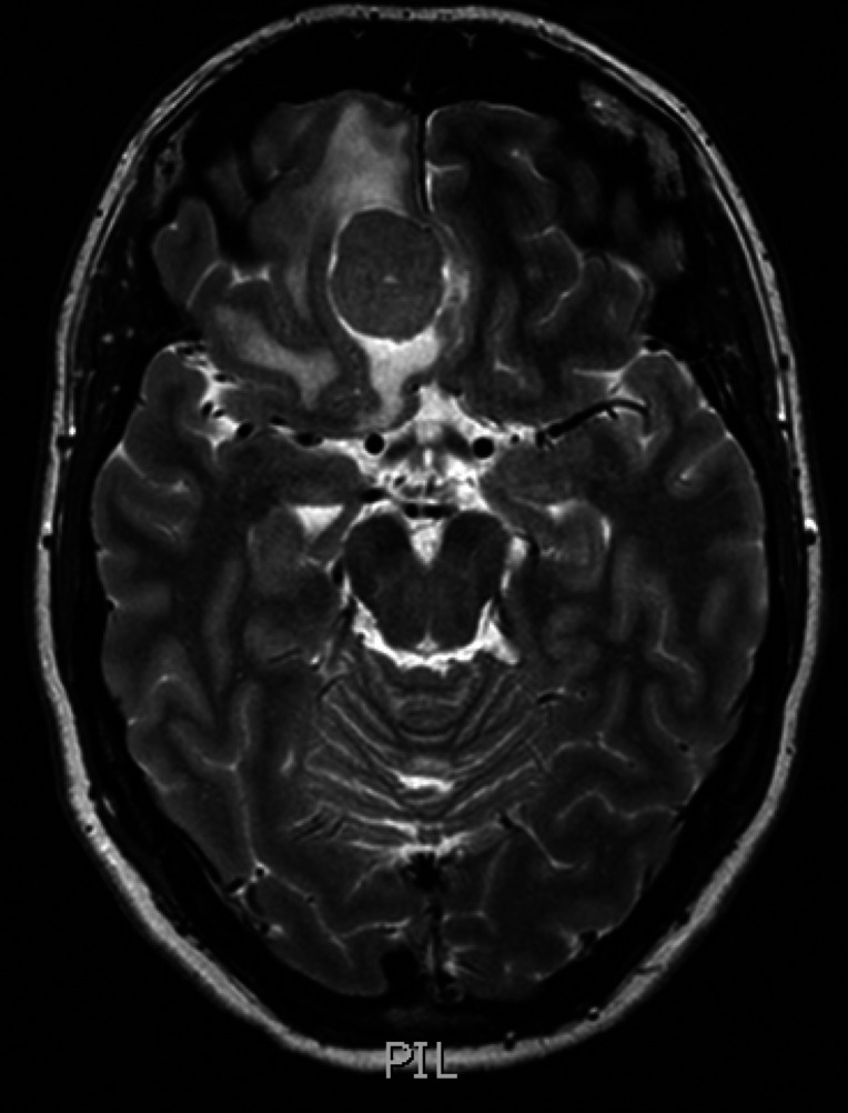 嗅沟脑膜瘤嗅觉丧失10年,手术后嗅觉可以恢复吗？