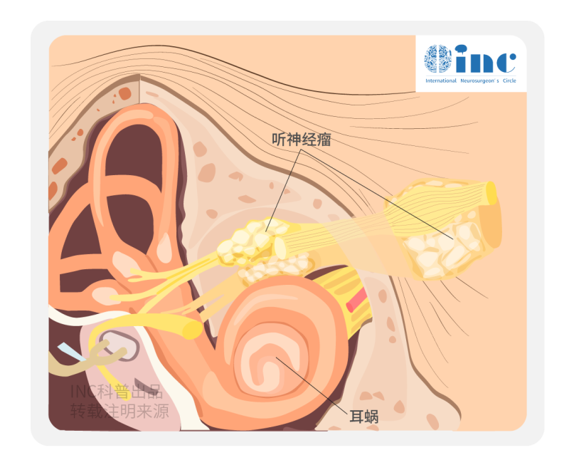 听神经瘤复发率高吗？听神经瘤复发的概率有多大