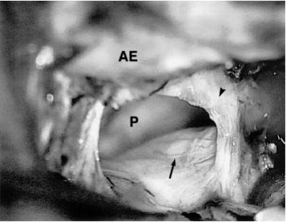 三叉神经瘤伽玛刀图片
