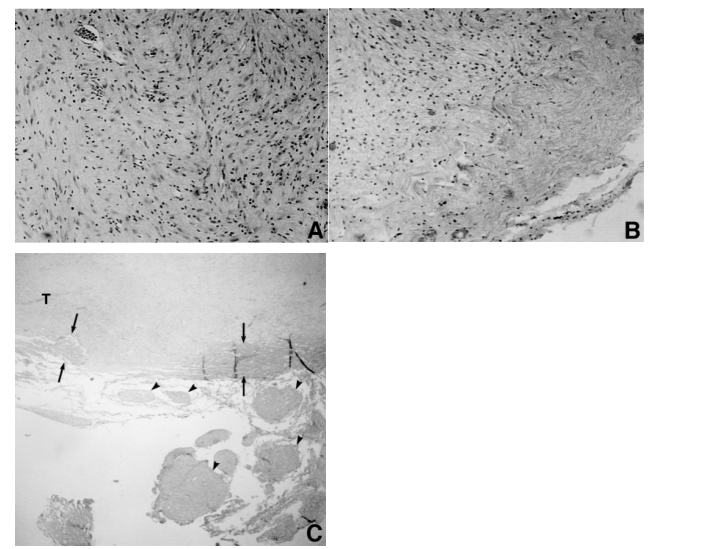 三叉神经瘤伽玛刀图片1
