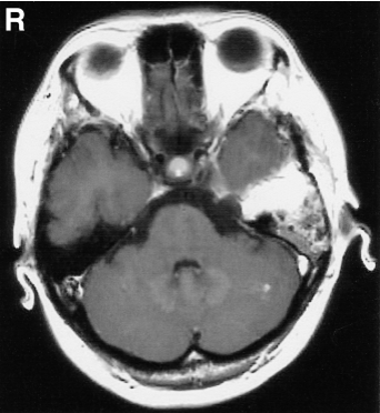 三叉神经瘤伽玛刀图片2