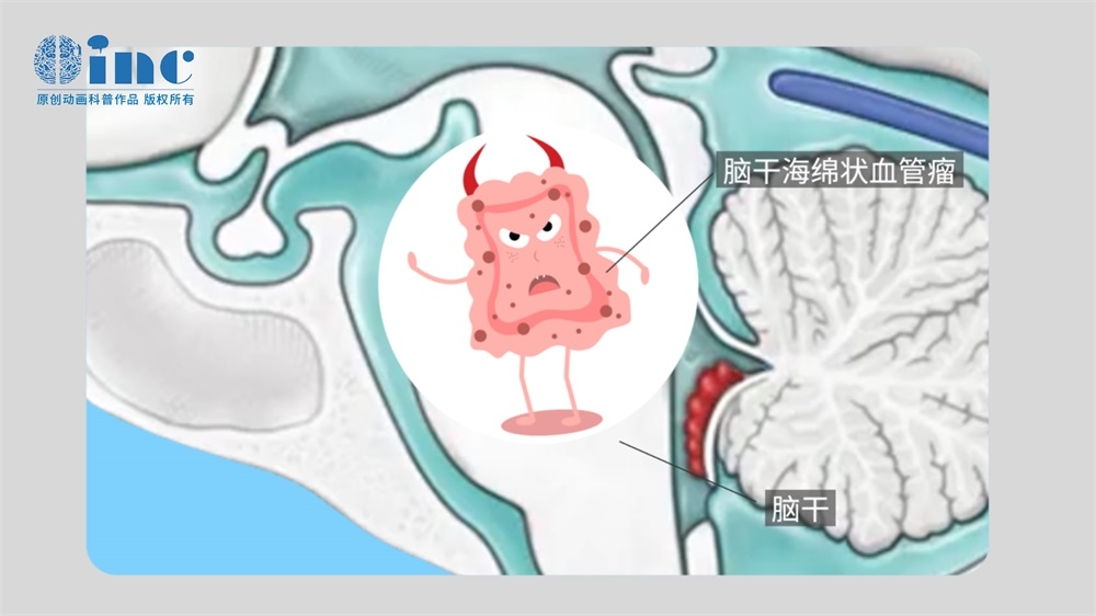 星形细胞瘤手术并发症