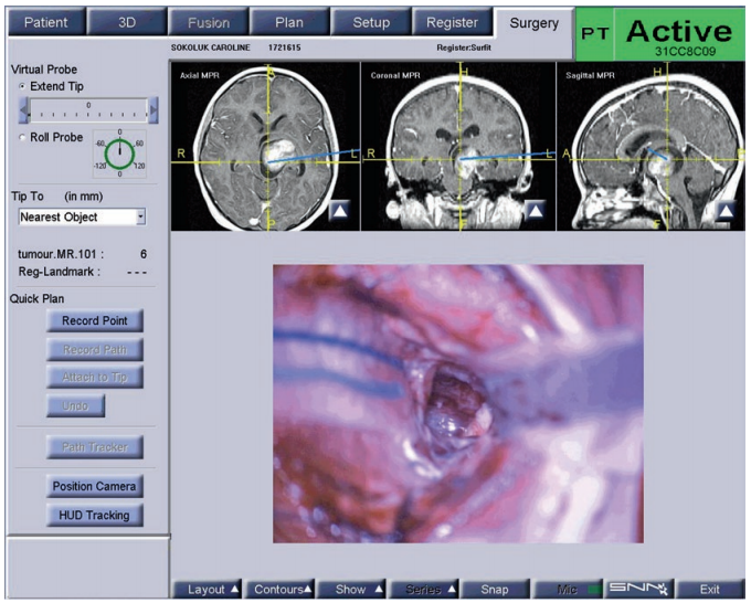 局灶性脑干胶质瘤治愈率图片