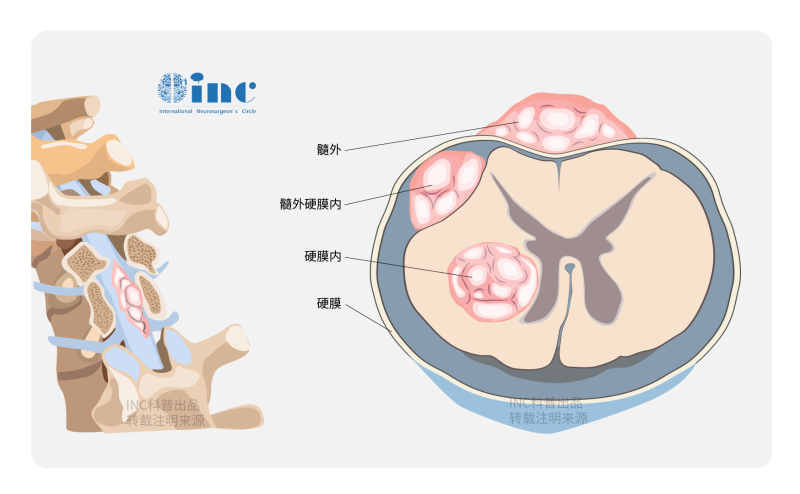 脊髓肿瘤能治好吗？脊髓肿瘤能治愈吗？