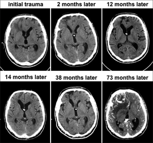儿童脑瘤是怎么引起的原因？儿童期头部创伤与儿童期脑瘤风险有关吗？