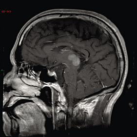 松果体区肿瘤案例
