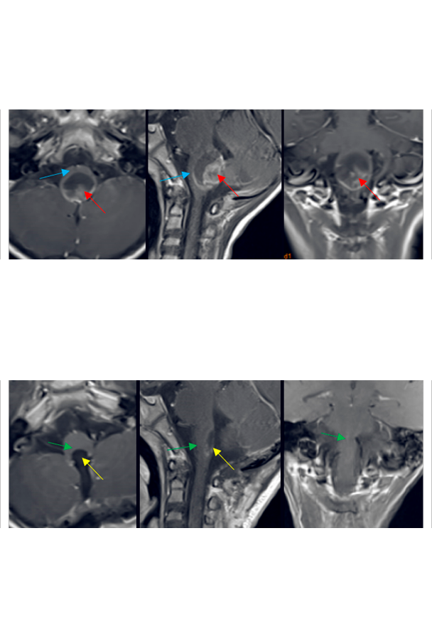 国外胶质瘤手术案例2