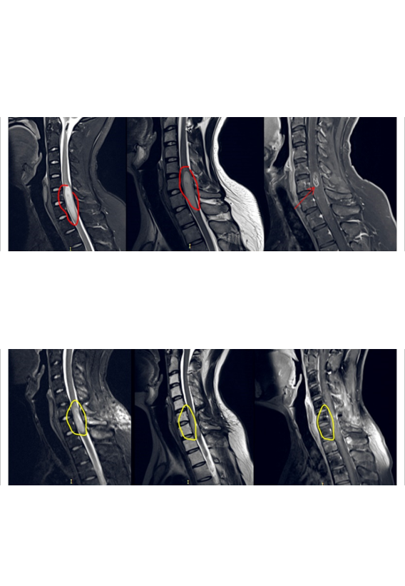国外胶质瘤手术案例3