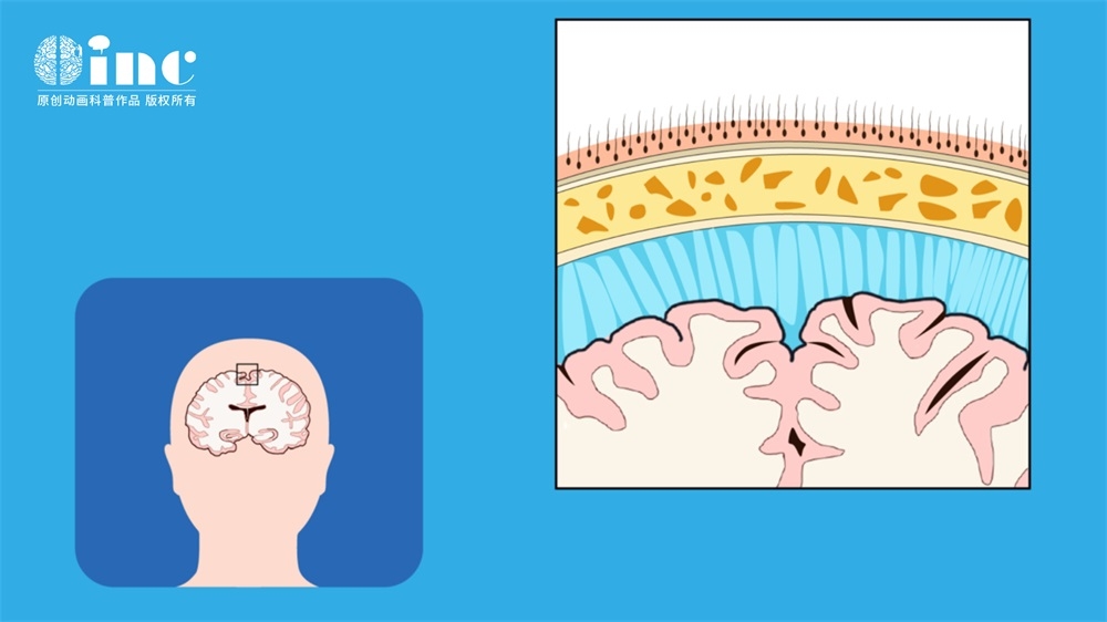 脑膜瘤是什么病，怎么治疗？脑膜瘤形成的原因