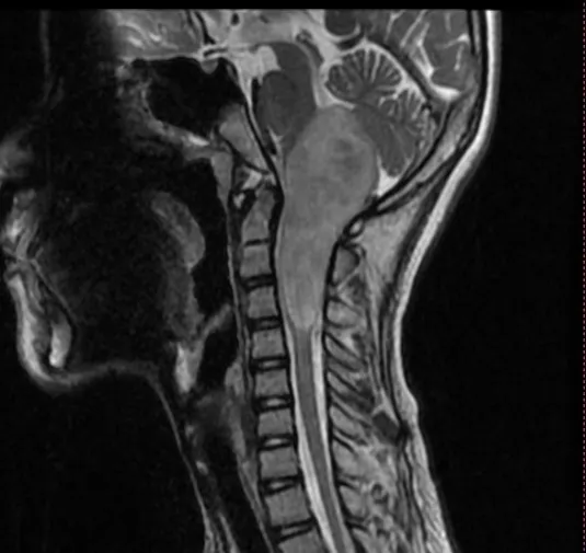 脑干延髓-颈髓胶质瘤手术难度大吗？