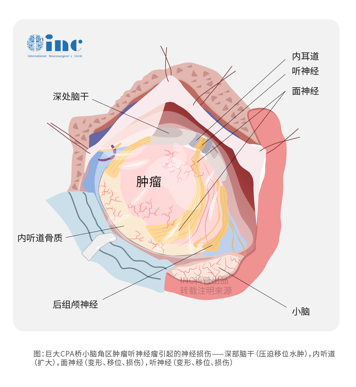 CPA桥小脑区肿瘤手术难度大吗？CPA区桥小脑角区脑膜瘤手术成功案例