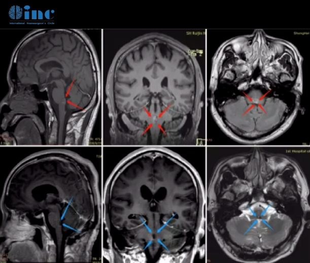 脑干海绵状血管瘤