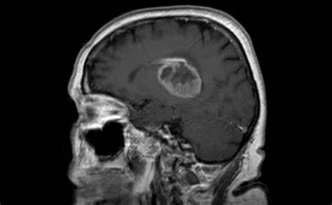 前沿进展：研究深入了解最致命的脑癌是如何复发的？