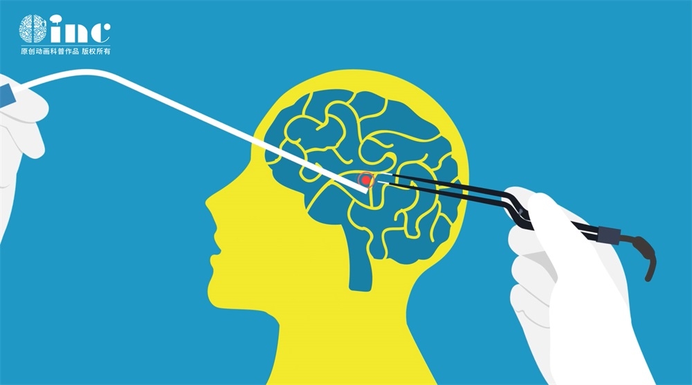 脑膜瘤会压迫视神经吗？视神经鞘脑膜瘤怎么治疗？