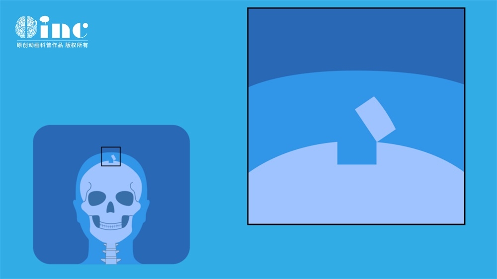 视神经肿瘤手术病发症，视神经肿瘤压迫手术后还能看见吗？