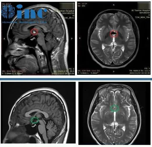脑室海绵状血管瘤