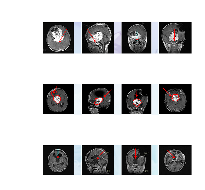 儿童视神经胶质瘤真的不能手术吗？5岁儿童手术后终于看清了巴教授的样子