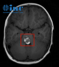 脑干海绵状血管瘤