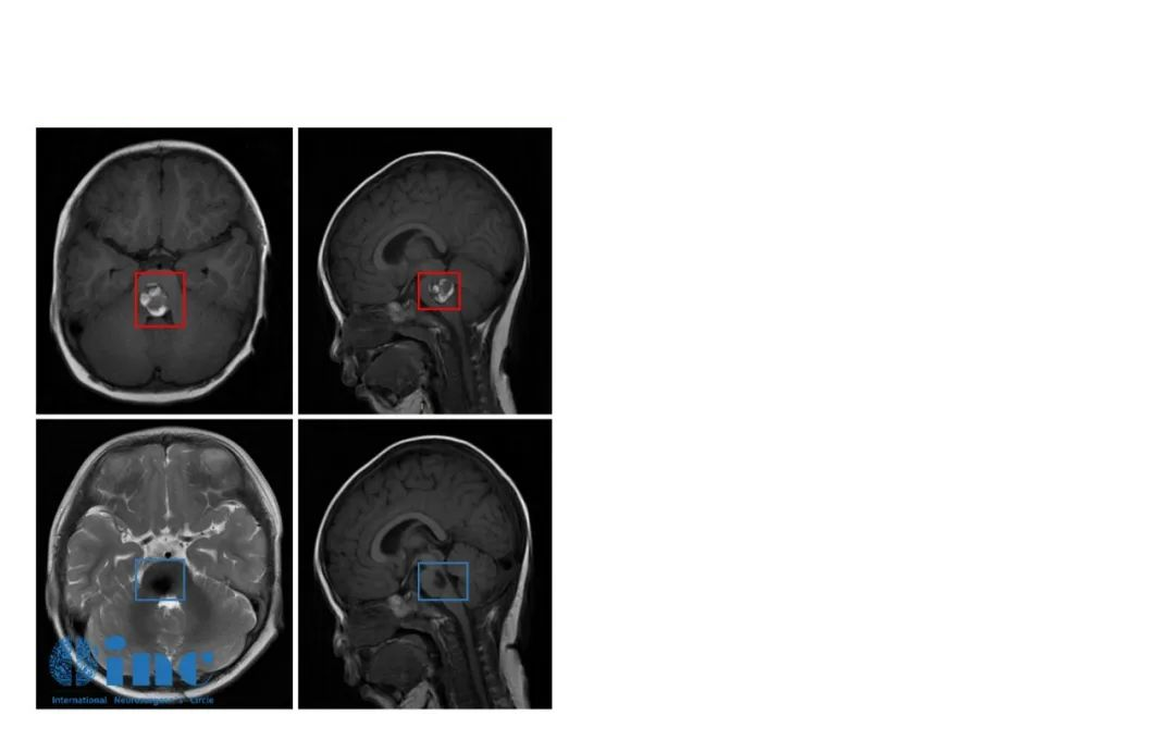 脑干海绵状血管瘤