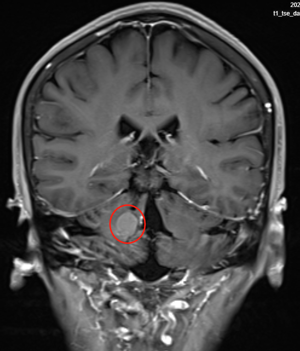 小脑海绵状血管刘