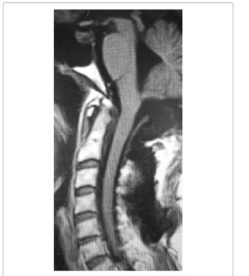 枕骨大孔脑膜瘤案例