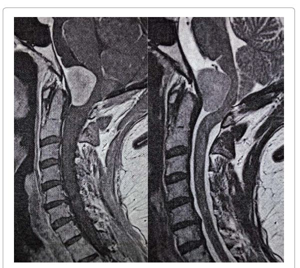 55岁枕骨大孔脑膜瘤全切案例