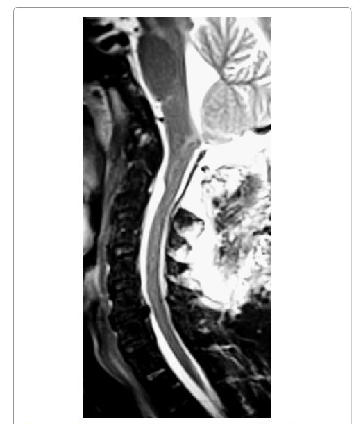 枕骨大孔脑膜瘤