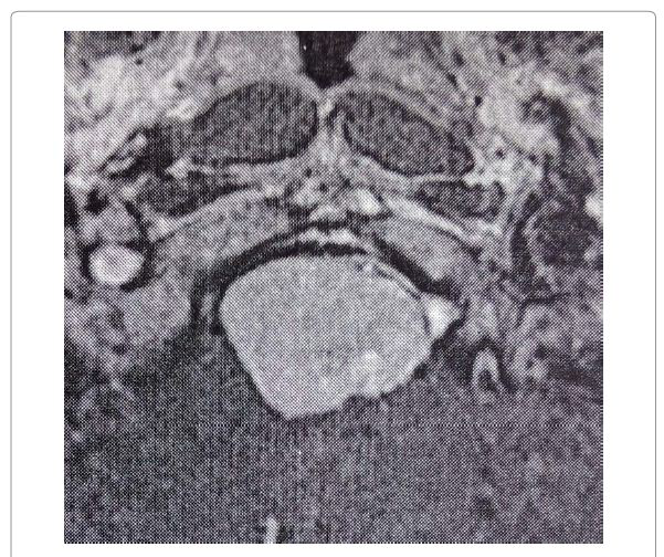 55岁枕骨大孔脑膜瘤全切案例图