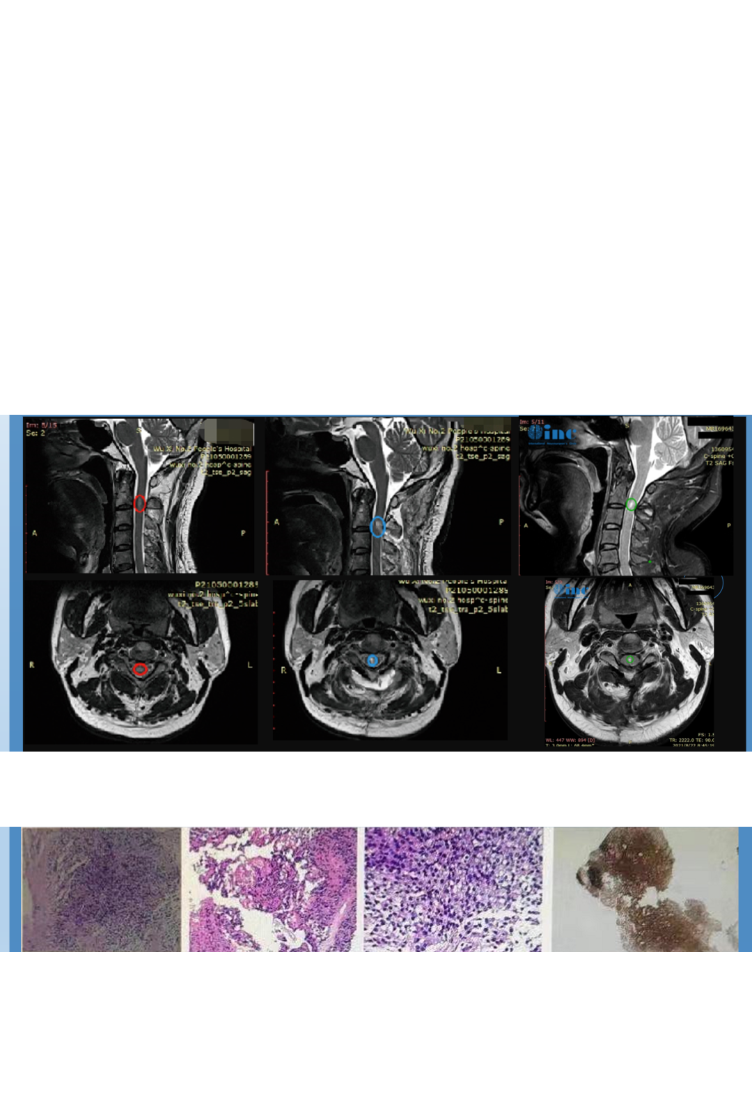 脊髓髓内肿瘤手术案例