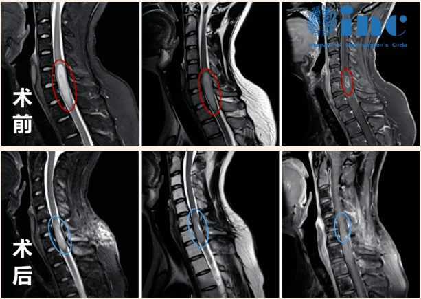 脊髓髓内肿瘤图片