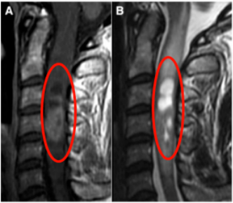 <a href='/bingzhong/jszl/' target='_blank'><u>脊髓肿瘤</u></a>
