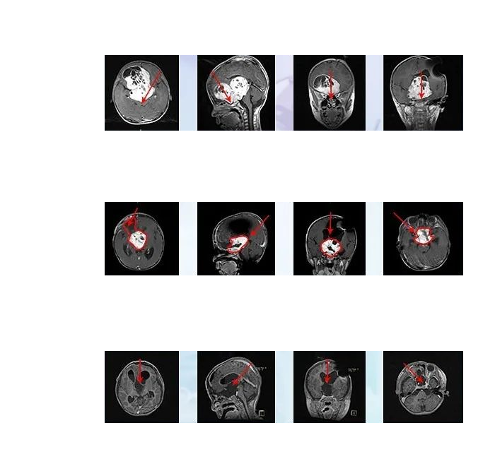 视神经胶质瘤手术