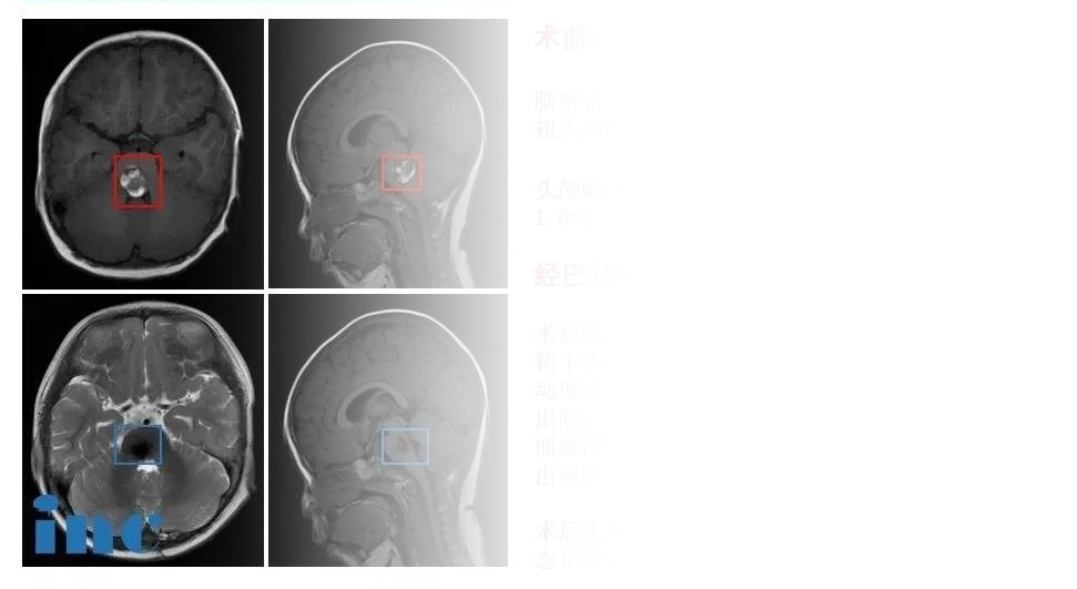 脑干海绵状手术术前术后