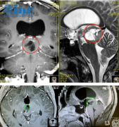 12年脑干中脑顶盖胶质瘤患者术后全切案例