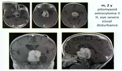 视神经胶质瘤手术成功案例分享