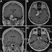 INC国际教授Kawase入路创始人切除岩斜脑膜瘤案例交流