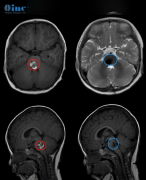 脑干海绵状血管瘤可以做手术吗？