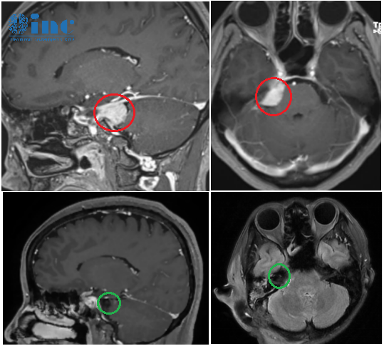 【INC巴教授全程手术纪实系列】脑膜瘤伽马刀治疗无效，一台手术安全全切、保听力、不面瘫
