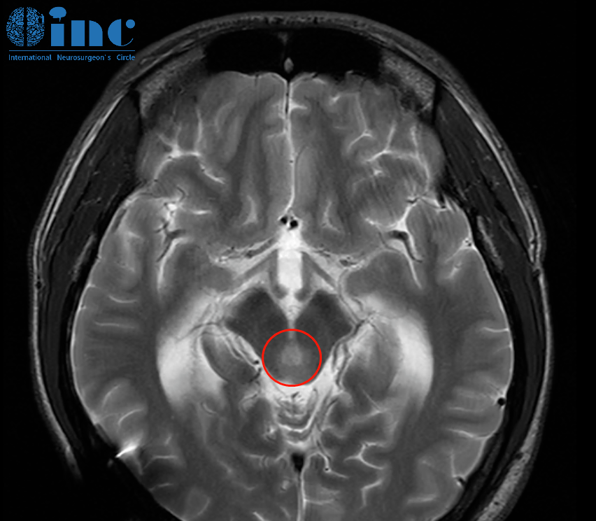脑干胶质瘤2月快速增大，术后即清醒、无瘫痪，INC国际教授如何一刀挽救21岁研究生？