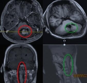 节细胞胶质瘤案例