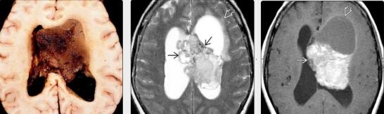 罕见脑瘤必知系列四：CNC中枢神经细胞瘤患者20个必知