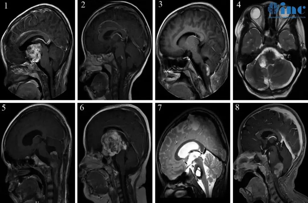 巴教授指导手术的8个病例的术前磁共振资料