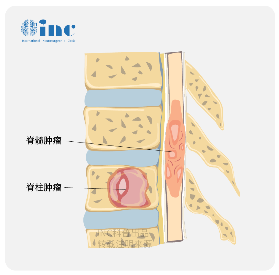 脊髓肿瘤找哪科手术？和脊柱手术的区别？热点问题答疑