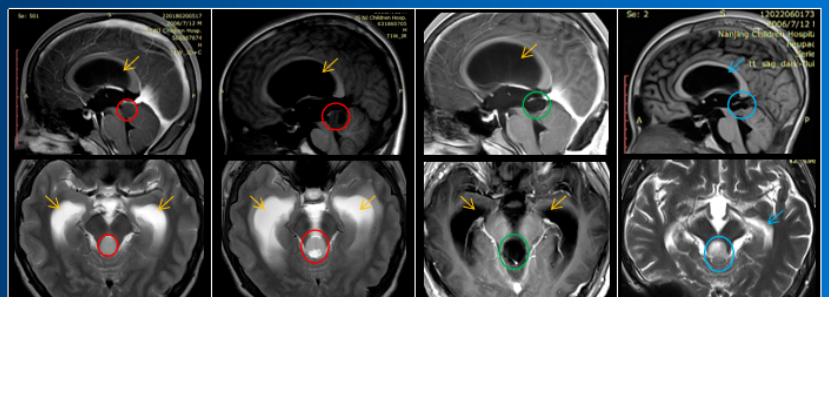 脑干胶质瘤保守治疗，2年 肿瘤压扁大脑