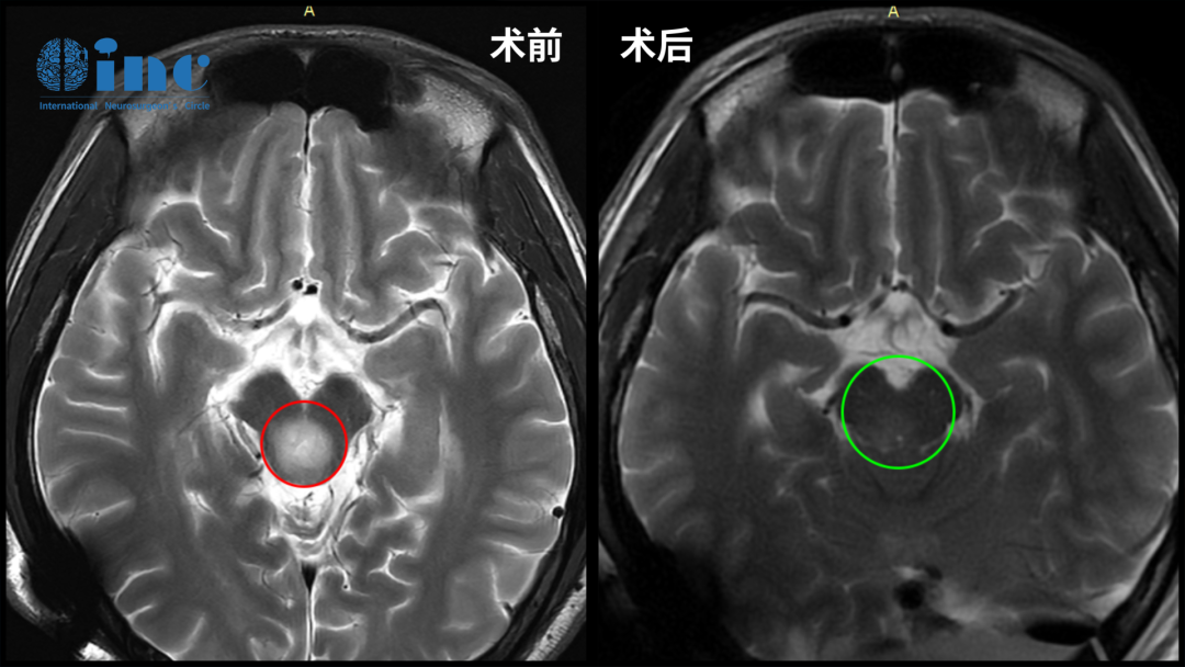 脑干低级别胶质瘤，2个月迅速生长6mm